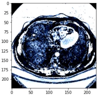 RSNA Dataset